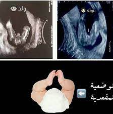 متى يبان نوع الجنين في السونار