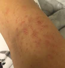 Was kann man gegen unreine haut tun? Kleine Pickel Nach Dem Epilieren Haut Beautytipps