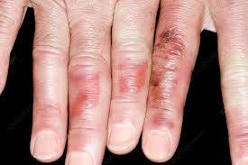 Image result for Chilblains
