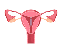 The copper iud is effective for 3 to 10 years, depending on which. What To Expect When You Get An Iud