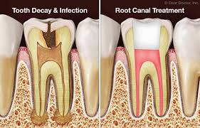 One of the main factors of how long it takes to complete a root canal is how infected. Dental Questions Why Do I Need A Root Canal If My Tooth Doesn T Hurt