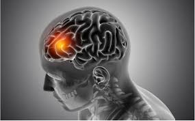 Image result for Thalamotomy