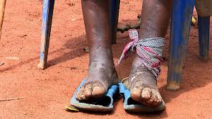 + body measurements & other facts. The Ugandan Village Devastated By Elephantiasis Bbc News