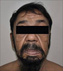 Acquired Cutis Laxa Associated with Light and Heavy Chain Deposition  Disease.