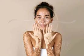 Image result for Vitiligo