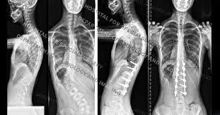 Check spelling or type a new query. Scoliosis In Children And Teenagers An Overview Hss
