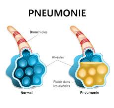 See full list on verywellhealth.com Pneumocoque Premiers Symptomes Transmission Et Traitements