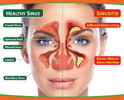 It can be very well treated with homeopathy without operation & surgery. 5 Best Homeopathic Medicines For Chronic Sinusitis Homeopathic Specialist Dr Harsh Sharma