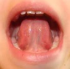 Frenillo Lingual Corto O Anquiloglosia Alba Lactancia Materna
