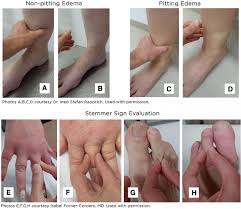 Image result for Edema Exam