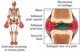 Rheumatoid Arthritis Physio Works