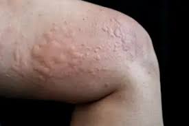 Image result for skin rash acute hiv infection