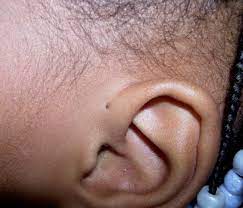 Learn About Preauricular Pits The Abnormal Hole In Your Child S Ear Infected Ear Piercing Ear Types Of Ear Piercings