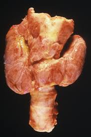Cancerous thyroid lumps aren't usually painful. Goitre Wikipedia