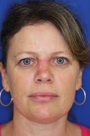 Like other skin cancers, it&#x27;s caused by prolonged exposure to the sun. Before And After Skin Cancer Photos