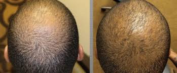 The black market world of dodgy hair transplants sold to 'desperate' hair loss sufferers 'there is an epidemic of companies with no experience, no ethics, no skill, no results, just paying. African Americans How Ethnicity Plays A Role In Hair Transplants Modena Hair Institute