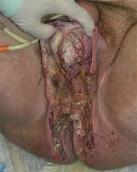 Fournier gangrene is necrotizing fasciitis of the perineum. Frontiers Fournier S Gangrene Lessons Learned From Multimodal And Multidisciplinary Management Of Perineal Necrotizing Fasciitis Surgery