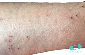 Image result for scabies symptoms