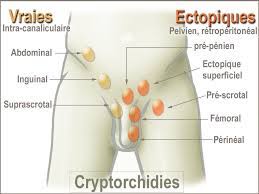 Cryptorchidism is the most common abnormality of male sexual development. Undescended Testicle Fertilitypedia