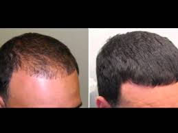 Before and after photos from real minoxidil products user: Minoxidil For Beard Results Novocom Top