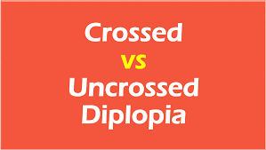 Crossed And Uncrossed Diplopia Simplified Pg Blazer
