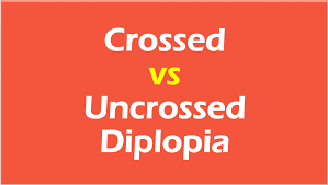 crossed and uncrossed diplopia simplified pg blazer