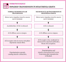 Mengenal Penyakit Unik Myasthenia Gravis Myasthenia Gravis Penyakit Autoimun Penyakit