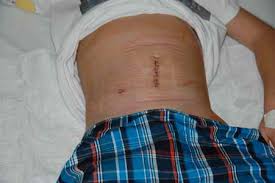 Jahr waren wir im krankenhaus mit verdacht auf eine blinddarmentzündung. Blinddarm In Deutschland