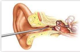 Ear Wax Cerumen Removal at best price in Ajmer by Dr. Vijay Ent Hospital |  ID: 17464090373