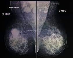 The most common symptoms of inflammatory breast cancer include redness, warmth. Inflammatory Breast Cancer Australia Pdf Ppt Case Reports Symptoms Treatment