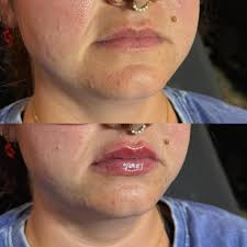My Experience with Lip Filler: Before, After, and the Healing Process