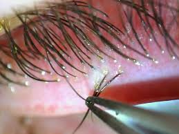 Image result for Demodex folliculorum