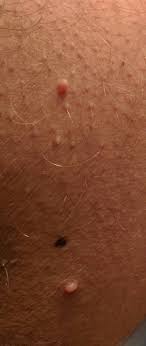 How To Get Rid Of Pimple Bumps On Inner Thighs