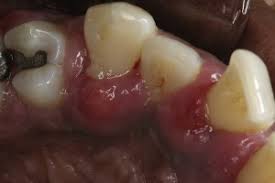 Image result for Periodontal Abscess