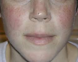 Lupus is a chronic autoimmune condition that can cause inflammation throughout your body. Pediatric Systemic Lupus Erythematosus Background Etiology Epidemiology
