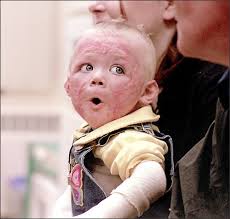 Spirited toddler begins to heal