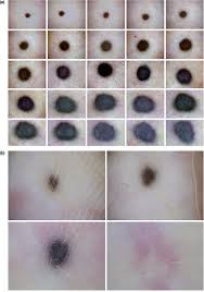 Image result for Blue Nevus