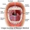 Tonsil cancer symptoms causes and treatments. 1