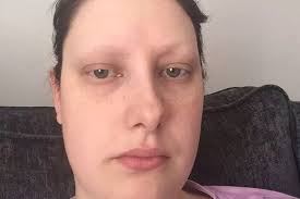 Young mum has rare condition which causes her to tear her eyebrows off and  pull out her hair