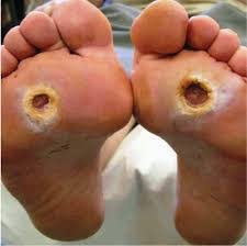 Image result for Wagner Ulcer Classification