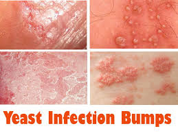 This Page Explains Some Of The Home Remedies For Yeast Infection And How They Can Be Effectively Cured Nature Yeast Infection Treatment Yeast Infection Causes Yeast Infection On Skin