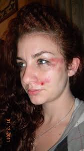 calvin's story: nicole's epilepsy