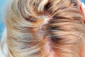 However, certain lifestyle choices and medical conditions can prevent this from happening. What Causes Scalp Fungus And The Best Treatment That Works Instantly