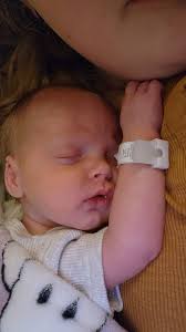 C-section incision opens after staples removed too soon