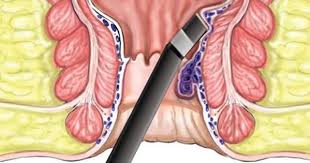 ماهي البواسير الداخلية وما أعراضها وأسبابها وكيفية علاجها laser treatment natural health tips treatment