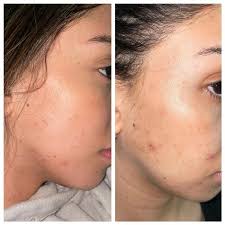Clinique even better clinical dark spot corrector is a product that might be able to give people some relief. Even Better Clinical Radical Dark Spot Corrector Interrupter Serum Clinique Sephora