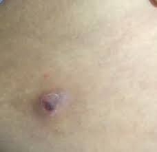 Ingrown hairs are hairs that curl and grow back into your skin after shaving or waxing. What Is This It S On My Inner Thigh Thought It Was An Ingrown Hair It Hurts Super Bad Walking Kinda Started Turning Purple Too Popping