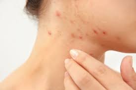 Scabies Rash What Does Scabies Look Like On Your Skin Neck Acne Scabies Rash Rash On Neck
