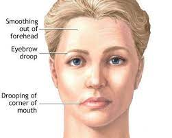 Potrivit top10homeremedies, simptomele spondilozei cervicale pot fi ameliorate cu ajutorul remediilor naturale. Paralizia Faciala Arhive Calivita Produse Naturiste