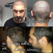 Sac Ekiminde 50 Gun Bizim Engin Sonmez Sac Ekimi Facebook